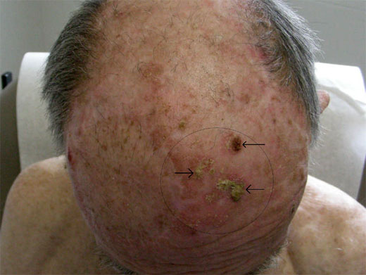 DA&Ntilde;O ACTINICO