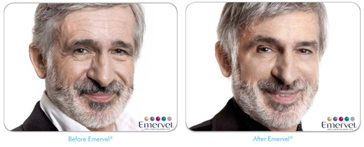 Emervel: antes y despu&eacute;s