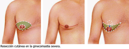 Resecci&oacute;n cut&aacute;nea en la ginecomastia severa.