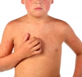 Clasificaci�n y causas del prurito