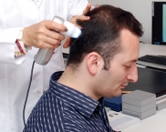 5 opciones para tratar la alopecia: mesoterapia, alta frecuencia, ultrasonido, PRP y terapias t�picas