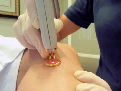 Terapia Fotodin�mica de V�rices