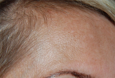 Demuestran la utilidad de la asociaci�n del �cido transex�mico y la niacinamida en el tratamiento del melasma